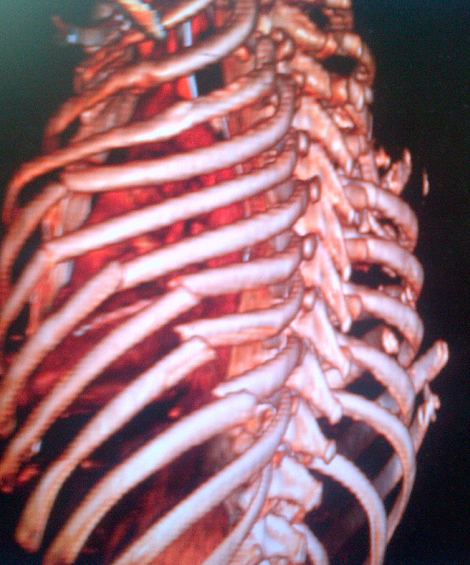 Rib fractures Flail Chest